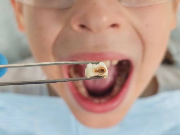 Best Emergency Treatment for Dental Infections or Abscesses in Tomah, WI